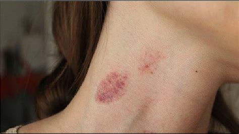 How to hide a hickey instantly? how to properly remove a hickey in minutes - best tutorial ...