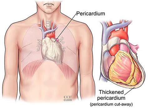 Information on pericarditis, inflammation of the membrane that lines the heart. Pericarditis | RMI