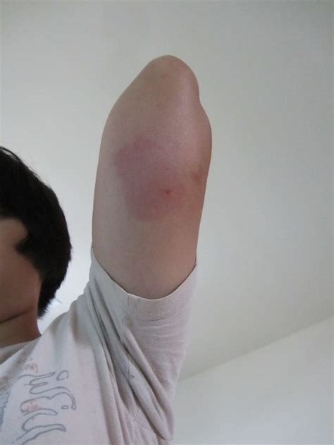 You all must have got mosquito bites once in a while. Best 77 Skeeter Syndrome Pictures images on Pinterest ...