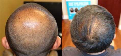 Being told that your hair looks like it could be thinning at the crown is certainly unnerving. Hair Transplants for a Thinning Crown
