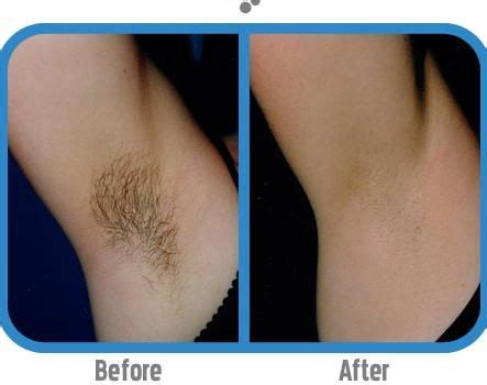 Check spelling or type a new query. Permanently Remove Unwanted Hair With no Ouch | Hair ...