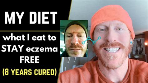 Extremely small quantities of this element are required in the human body for optimal health but according to the melisa foundation, nickel consumption or exposure triggers more allergic reactions than any other element, and approximately 15% of the human population suffers from a nickel allergy. What I EAT to stay ECZEMA free (diet advice fro skin ...