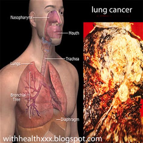 Defining the stages of primary and metastasized tumors can help to guide patients and carers using best practice cancer management strategies. What Does it Mean Stage 4 Lung Cancer and Other Stage ...