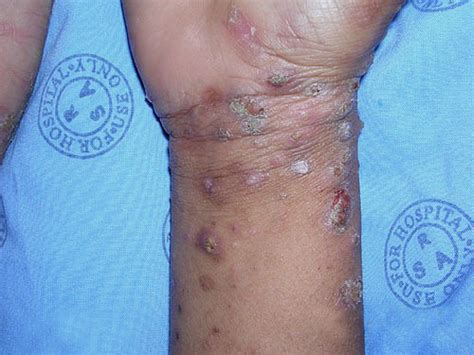 Dermatozoonoses (escabiose sarcoptes scabiei, pediculose do couro cabeludo dermatozoonoses. Piolhos subcutâneos humanos - é um mito, ou são mesmo?