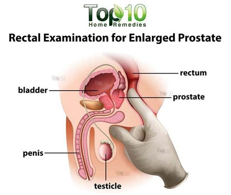 Prostate massage should never be used as a substitute for the diagnosis or treatment of an enlarged. Prostate diagram
