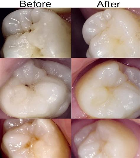 How long does it take to straighten teeth with braces? How Many Set Of Teeth Do We Have | Animal Enthusias Blog