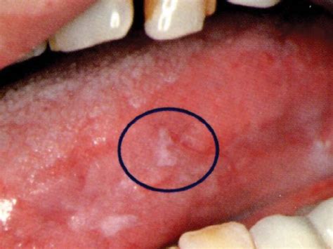 What does mouth cancer look like. New Saliva Test For Oral Cancer