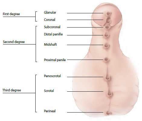 Hipospadia tergolong cacat lahir, dimana ujung uretra tidak terletak pada ujung penis, melainkan berada pada bagian bawah penis. Congenital malformations of genital organs | Birth Defects ...