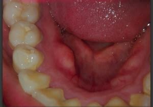 Maybe you would like to learn more about one of these? sospechoso bulto en la encía