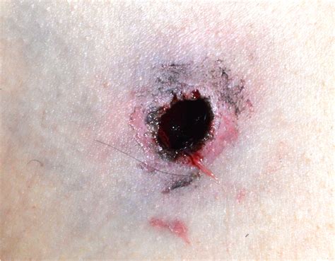 Gunshot wounds are among the most complex traumatic lesions encountered in forensic pathology. Pathology Outlines - Gunshot wounds