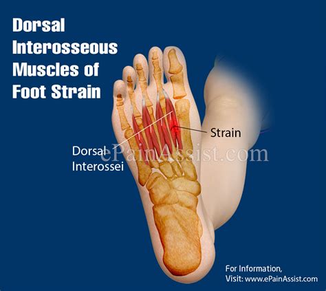 Foot muscles and tibialis posterior with chronic plantar. Dorsal Interosseous Muscles of Foot Strain|Causes ...