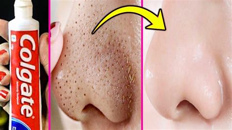 Witches in fairy tales are commonly depicted as having warts on their noses. How To Get Rid Of Blackheads On Nose With Toothpaste ...
