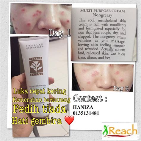 Cara hilangkan 'sunburn' dalam masa yang singkat !! Pengedar Shaklee Klang Dan Banting 0135131481: Cara ...