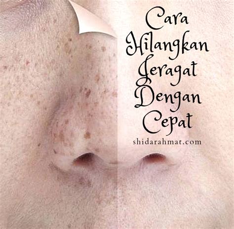 Cara Hilangkan Jeragat Dengan Cepat ~ shidarahmat
