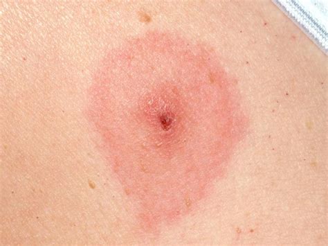 After a tick bite, a small swelling or spot with in the middle a red dot where the tick used to be can be seen on the skin. LIME DISEASE PANDEMIC (cours en anglais) - Stadium PhysiOsteo