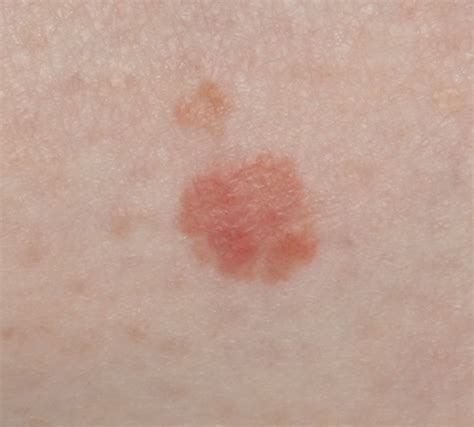 Most cases of squamous cell carcinoma can be cured when found early and treated properly. cancer genome: Skin Cancer - Types, Risks, Symptoms And ...