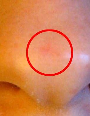 Some jump to the conclusion that their child might have cancer. Woman's herbal remedy she used for skin cancer ROTTED her ...
