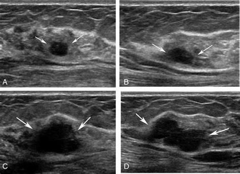Doctors often use ultrasound to guide a needle to do a biopsy (taking out fluid or small pieces of tissue to be looked at under a microscope). Breast ultrasound images for a 46-year-old woman with an ...