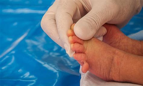 Anda ada masalah sakit ibu jari kaki? Polidaktili, Kelainan yang Sebabkan Bayi Lahir dengan ...