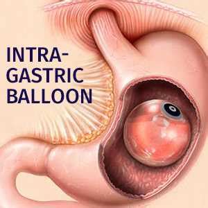 Have obesity, especially if you are a woman; Get The Best Treatment Of Gallstones In Pune An Affordable ...