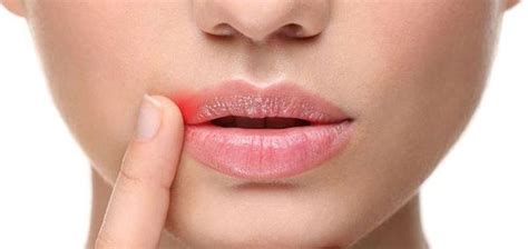 After all, they share one thing in common: How To Quickly Treat Cold Sores - Lindgren Dental Care