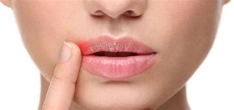 The majority of typically, cold sores appear on the lips, chin, cheeks, inside the nostrils. How To Quickly Treat Cold Sores - Lindgren Dental Care