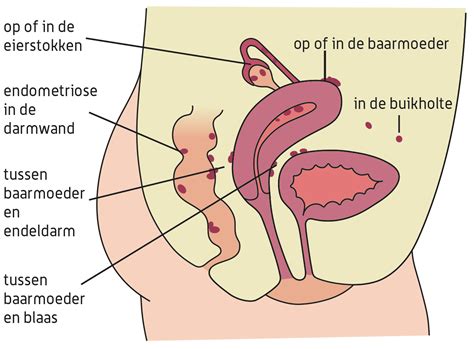 Dit doen we met een team van 21 goed toegeruste vrijwilligers en 2 parttime medewerkers. Endometriose | St. Antonius Ziekenhuis