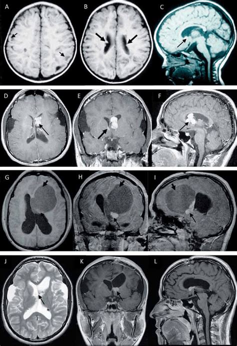 Scleroza multiplă este o boală care afectează nervii măduvei spinarii şi cei de la nivelul creierului, cauzând probleme musculare, de echilibru şi de vedere. RMN cerebral durante el período de observación radiológica ...