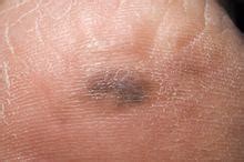 Les principaux symptômes sont les suivants Méfiez-vous du cancer des pieds