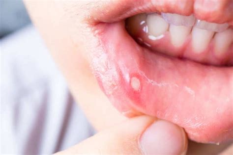 Punca ulser mulut yang pertama ialah disebabkan oleh cuaca yang terlalu panas. Awas Ulser Mulut Berbahaya, Lagi-lagi Yang Pakai Braces ...