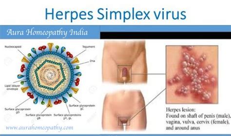 Infections are categorized based on the part of the body infected. Homeopathic Treatment For Herpes Simplex Virus: Cold Sores (Homeopathy) ~ Homeopathy doctor in Delhi