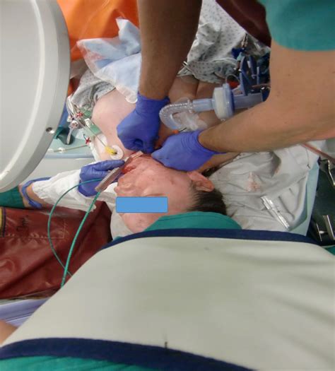 Ventilator settings documented while on a conventional mode of ventilation are to be used to select daily minimum peep and fio2 values for the calendar day. First DLeT in the Fs, a second DLeT is used for distal ...