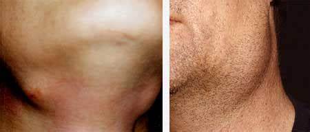 Диета при воспалении слюнной железы Воспаление желобовидных сосочков на корне языка - журнал стоматолога Воспаление желобовидных сосочков на корне языка - журнал стоматолога Диета при воспалении слюнной железы