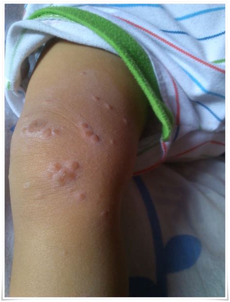 Oleh sebab itu, kita perlu sering. Journey Of Life: Aqil kena penyakit HFMD @ kaki tangan dan ...