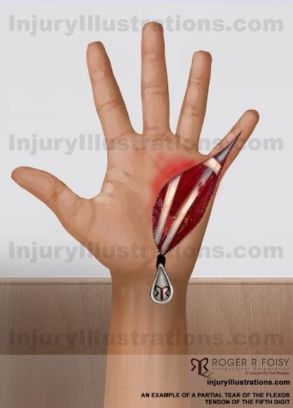 Participants with nerve injuries associated with the trauma causing the current flexor tendon. Personal Injury Potential Settlement Values: Wrist and ...