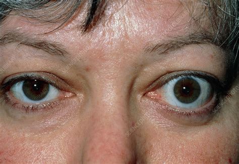 Exophthalmos may be accompanied by other signs. Bulging eye (exophthalmos) due to thyrotoxicosis - Stock ...