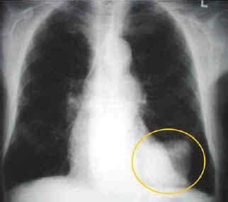 Confusion and weakness, particularly favoring one side of the body, are other key signs to watch for. TyPes Of CanCer