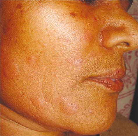 Herpes is one of the most common sexually transmitted diseases which can affect multiple organ systems including the lips and genitals. herpes on face pictures - pictures, photos