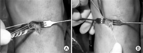 These anchors offer the benefits, clinical experience and product support surgeons have come to appreciate from arthrex. (A) Bioabsorbable suture anchor (Duet Suture Anchor ...