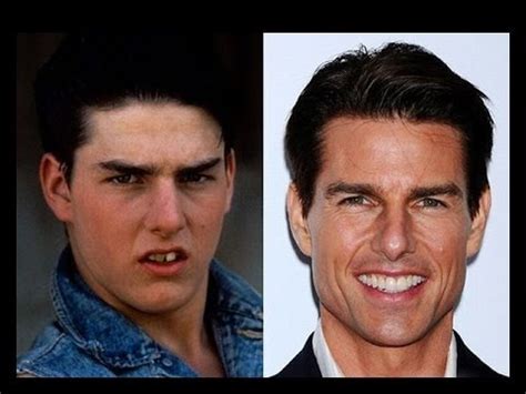Celebrity hollywood before and after plastic surgery ...