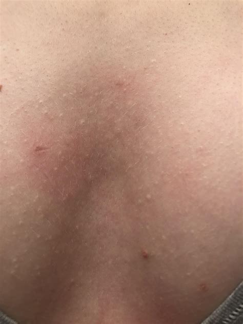 For about 6 months now i have had this itchy spot on my shih tzu with skin irritation and little bumps all over beauty & personal care: I have all these little white bumps on my chest (not itchy ...