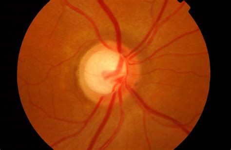 A high intensity beam of light is carefully aimed at openings in the eye's drainage system. Glaucoma ocular ¿qué es y cómo se produce? | Miranza