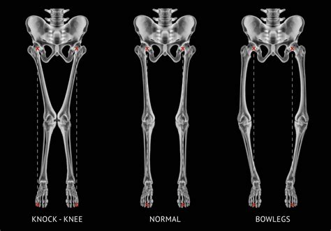 Tulang kompak pada sel tulang (osteosit) tersusun dan membentuk sistem havers. Kelainan Tulang dan Sendi Pada Kaki Anak, Orang Tua Wajib ...