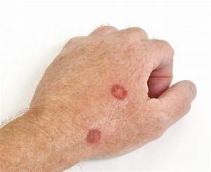 Figo! 15+ Elenchi di Melanoma Skin Cancer On Finger? Sunlight contains ultraviolet light that is ... Skin Cancer  