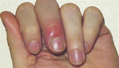 Paronychia is a skin infection around the fingernails or toenails. 5 Home Remedies To Treat Paronychia - lifeberrys.com