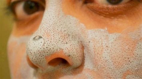Pimples on the nose, near the nose and inside the nose! How to get rid of Blackheads naturally at home ...