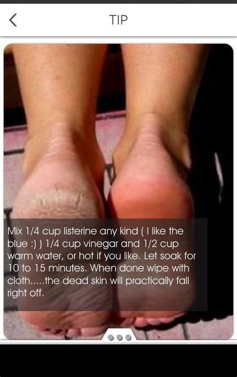 From cracked heels to those pesky dry patches on the soles of you feet, here's how to remove dead skin max out your at home pedicure with a quick slick of nail polish. How To Get Rid Of Dry/Rough Skin On Your Feet | Beauty ...