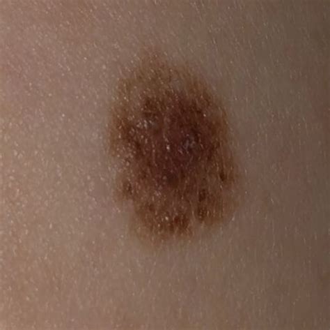 Maybe you would like to learn more about one of these? Sieht das aus wie Hautkrebs oder eher nicht? (Gesundheit ...