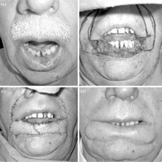 Purpose the fujimori gate flap is an innervated flap raised from the nasolabial area for reconstruction of the lower lip. (PDF) Fujimori gate flap: an old flap for reconstruction ...