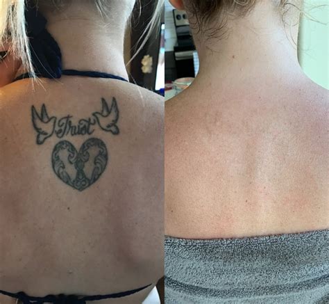 Tattoo removal is a popular procedure, and thanks to new laser technology known as picosure, it is more effective than ever. My tattoo removal experience — Beauty and Lifestyle Blog ...